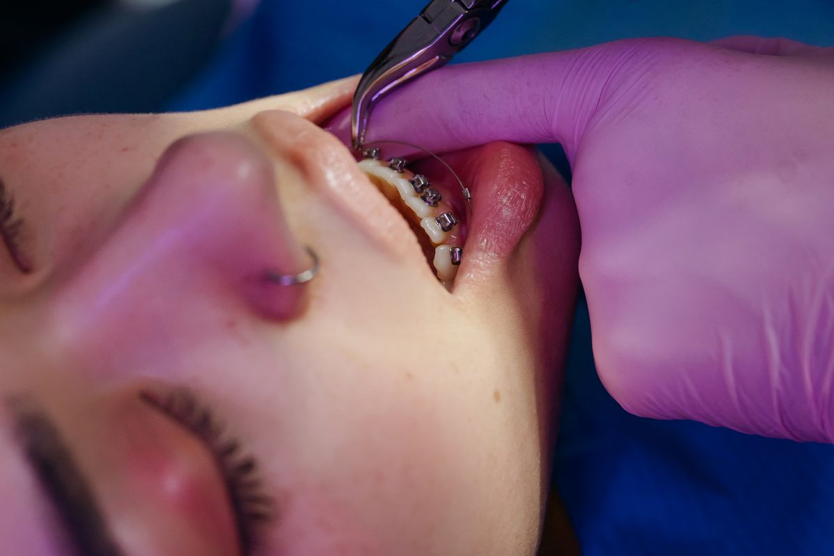 Metal Braces